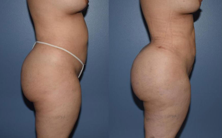 Dr Curtis Brazilian Butt Lift before and after
