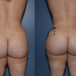 Thumbnail of http://Dr%20Curtis%20Brazilian%20Butt%20Lift%20before%20and%20after