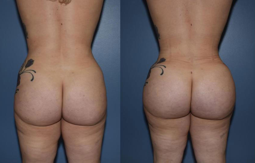 Dr Curtis Brazilian Butt Lift before and after