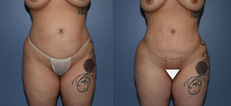 Dr Curtis Brazilian Butt Lift before and after