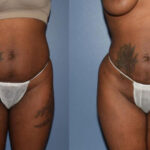 Thumbnail of http://Dr%20Curtis%20Brazilian%20Butt%20Lift%20before%20and%20after