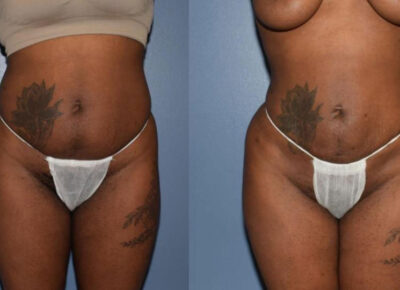 Brazilian Butt Lift Patient 5