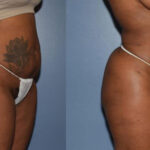 Thumbnail of http://Dr%20Curtis%20Brazilian%20Butt%20Lift%20before%20and%20after