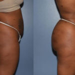 Thumbnail of http://Dr%20Curtis%20Brazilian%20Butt%20Lift%20before%20and%20after