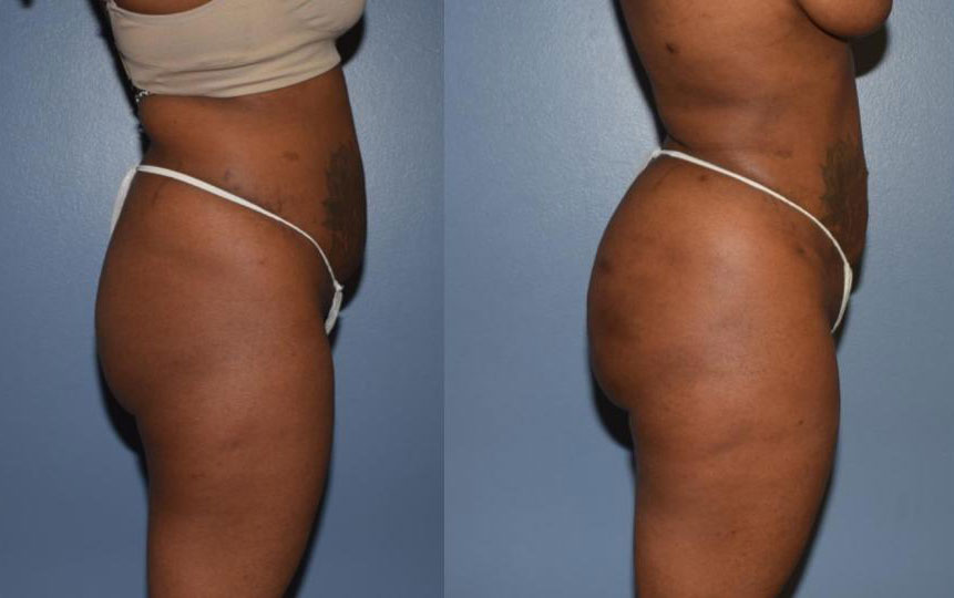 Dr Curtis Brazilian Butt Lift before and after