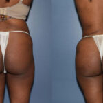 Thumbnail of http://Dr%20Curtis%20Brazilian%20Butt%20Lift%20before%20and%20after