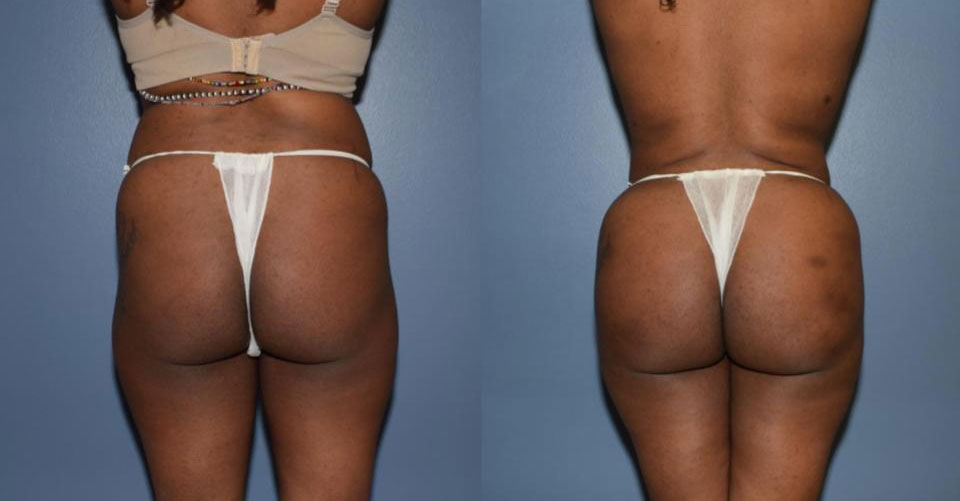Dr Curtis Brazilian Butt Lift before and after