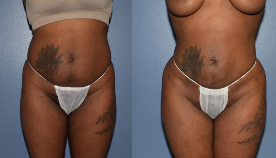 Dr Curtis Brazilian Butt Lift before and after