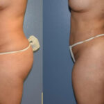 Thumbnail of http://Dr%20Curtis%20Brazilian%20Butt%20Lift%20before%20and%20after