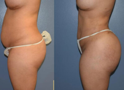 Brazilian Butt Lift Patient 6