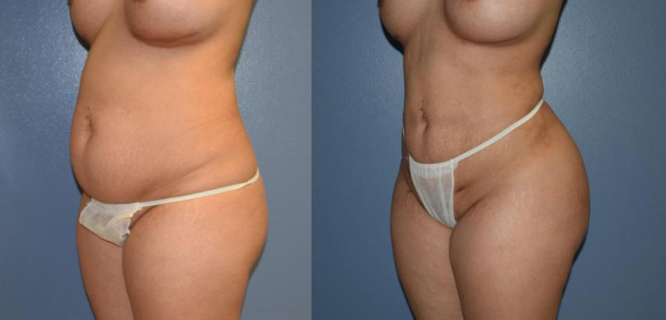 Dr Curtis Brazilian Butt Lift before and after