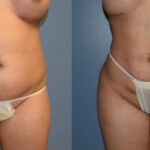 Thumbnail of http://Dr%20Curtis%20Brazilian%20Butt%20Lift%20before%20and%20after