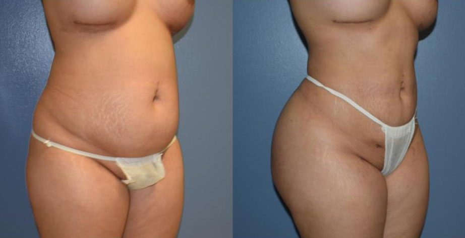 Dr Curtis Brazilian Butt Lift before and after