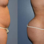 Thumbnail of http://Dr%20Curtis%20Brazilian%20Butt%20Lift%20before%20and%20after