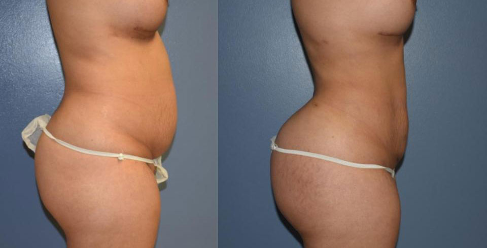 Dr Curtis Brazilian Butt Lift before and after