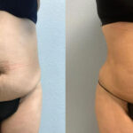 Thumbnail of http://Dr%20Curtis%20Brazilian%20Butt%20Lift%20before%20and%20after