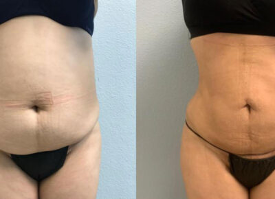 Brazilian Butt Lift Patient 7