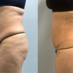 Thumbnail of http://Dr%20Curtis%20Brazilian%20Butt%20Lift%20before%20and%20after