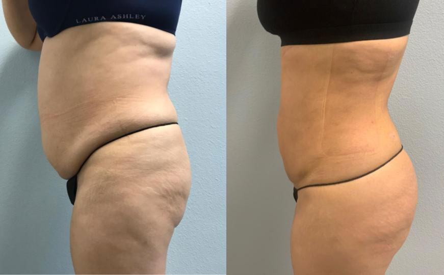 Dr Curtis Brazilian Butt Lift before and after