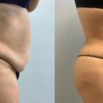 Thumbnail of http://Dr%20Curtis%20Brazilian%20Butt%20Lift%20before%20and%20after