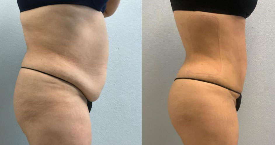 Dr Curtis Brazilian Butt Lift before and after