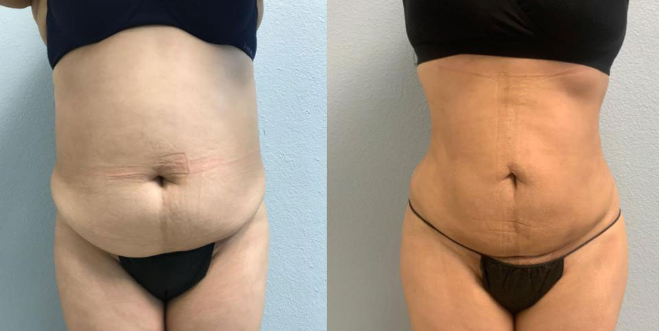 Dr Curtis Brazilian Butt Lift before and after