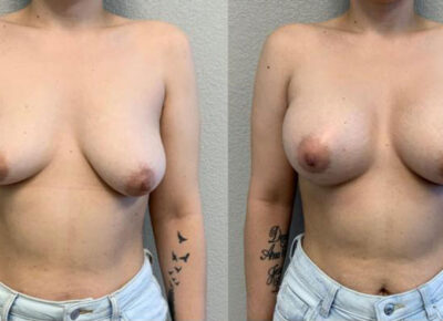 Breast Augmentation Patient 1