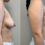 Thumbnail of http://Breast%20Augmentation%20before%20and%20after%20side%20view