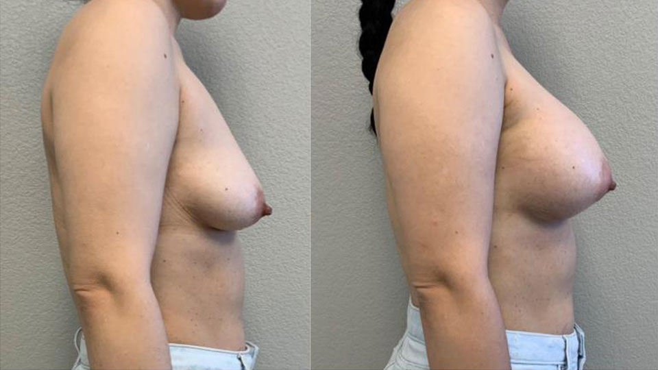 Breast Augmentation before and after side view