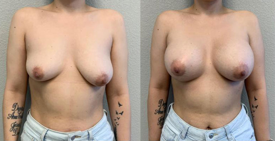 Breast Augmentation before and after