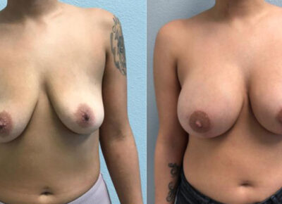 Breast Augmentation Patient 10