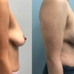 Thumbnail of http://Breast%20Augmentation%20before%20and%20after%20side%20view