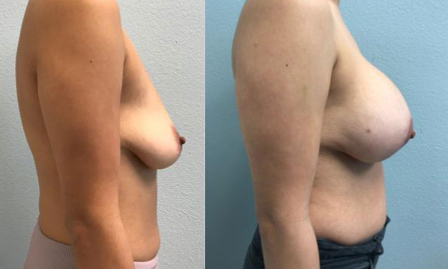 Breast Augmentation before and after side view