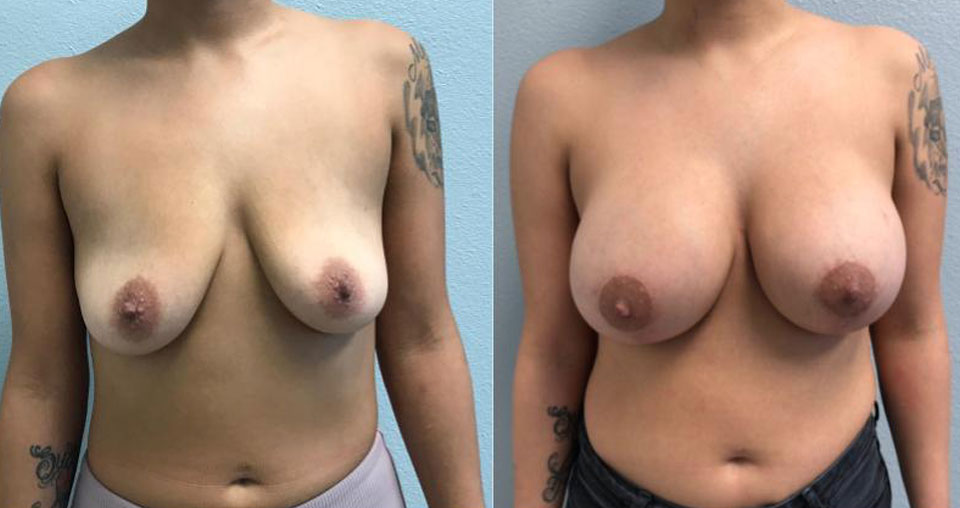 Breast Augmentation before and after