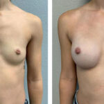 Thumbnail of http://Breast%20Augmentation%20before%20and%20after