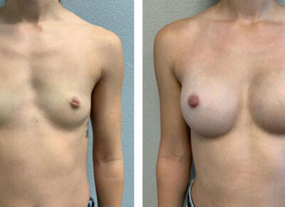 Breast Augmentation Patient 11