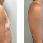 Thumbnail of http://Breast%20Augmentation%20before%20and%20after%20side%20view