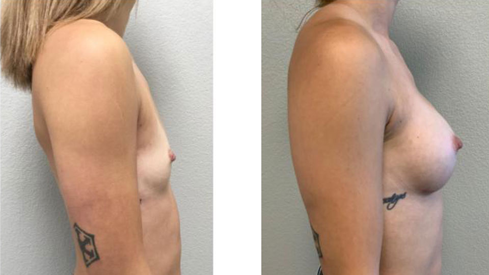Breast Augmentation before and after side view