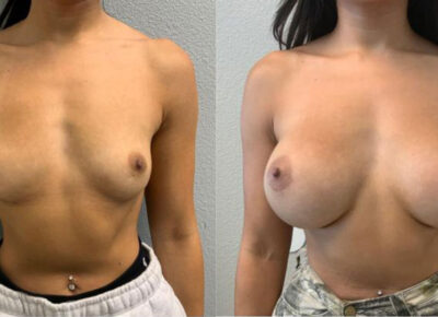 Breast Augmentation Patient 3
