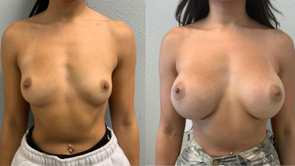 Breast Augmentation before and after