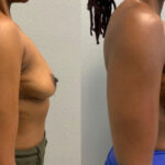 Thumbnail of http://Breast%20Augmentation%20before%20and%20after