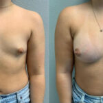 Thumbnail of http://Breast%20Augmentation%20before%20and%20after
