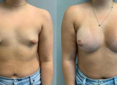 Breast Augmentation Patient 5