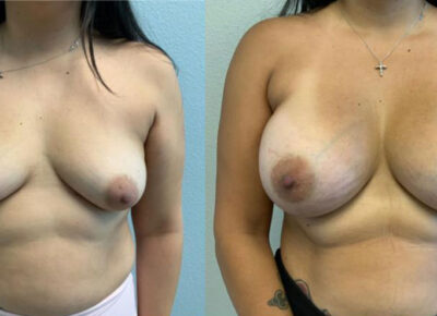 Breast Augmentation Patient 6