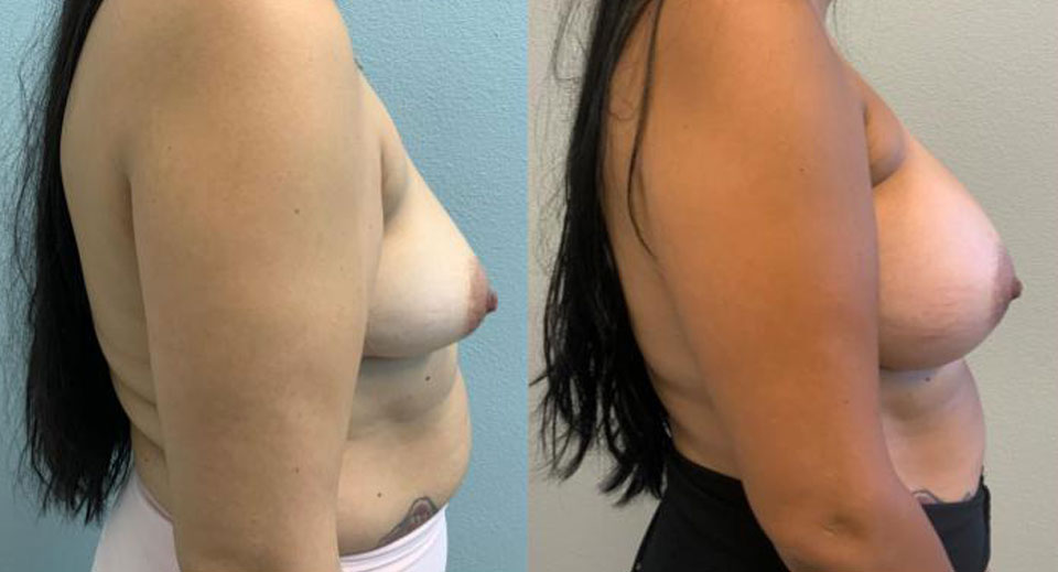Breast Augmentation before and after side view