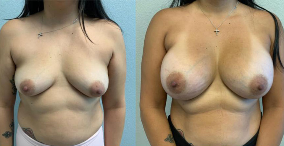 Breast Augmentation before and after