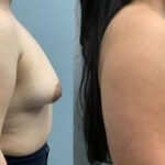 Thumbnail of http://Breast%20Augmentation%20before%20and%20after%20side%20view