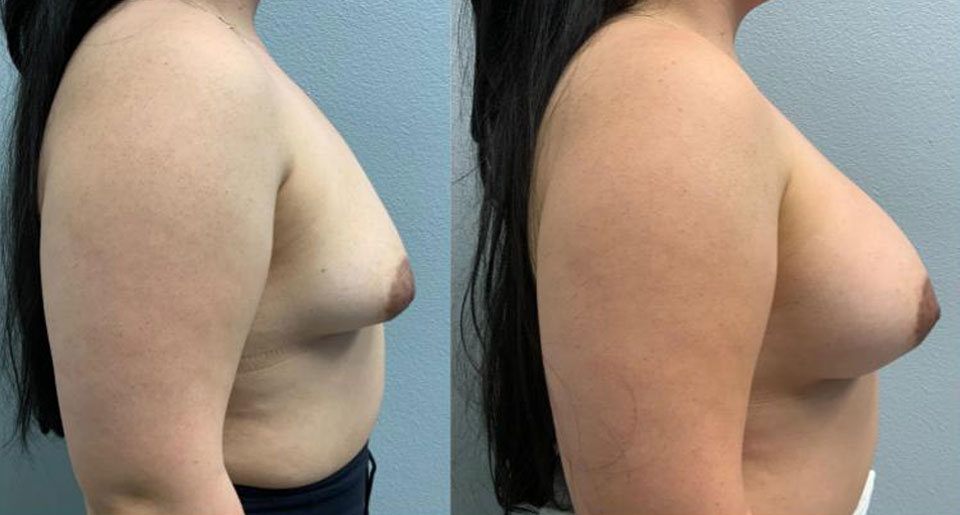 Breast Augmentation before and after side view