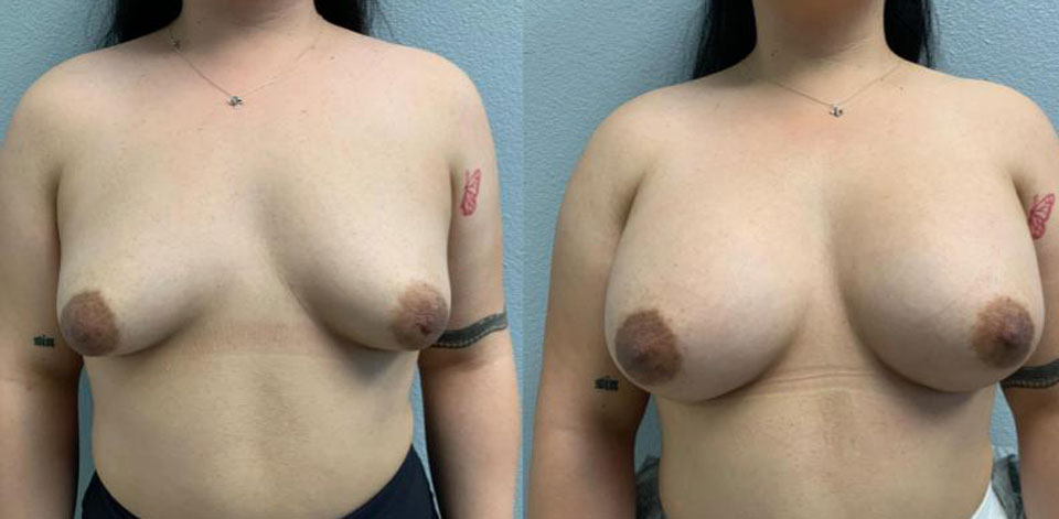 Breast Augmentation before and after