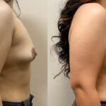 Thumbnail of http://Breast%20Augmentation%20before%20and%20after%20side%20view